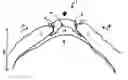 Fig. 01 - Accommodating or focusable contact lens