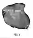 Fig. 02 - Enhanced coronary viewing