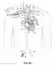 Fig. 22 - TWO-PIECE TRANSSEPTAL CANNULA, DELIVERY SYSTEM, AND METHOD OF DELIVERY
