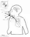 Fig. 03 - Systems, devices, and methods including infection-fighting and monitoring shunts