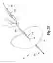 Fig. 35 - SURGICAL INSTRUMENTS FOR IN VIVO ASSEMBLY