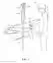 Fig. 02 - Medical Valve with Multiple Variable Volume Regions