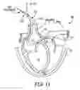 Fig. 09 - Methods and systems for accessing the pericardial space