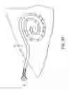 Fig. 08 - Transdermal venous access locking solution