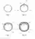 Fig. 04 - TRACHEOBRONCHIAL PULMONARY CRYOGENIC THERAPEUTIC METHOD AND APPARATUS