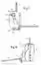 Fig. 06 - Self-centring elbow fixation device without guide wire