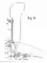 Fig. 08 - Self-centring elbow fixation device without guide wire