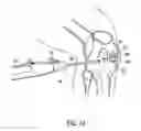 Fig. 09 - Microfracture instrument