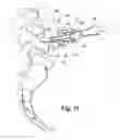 Fig. 16 - Instruments and techniques for separating bony structures