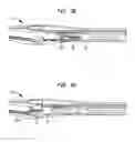 Fig. 13 - Clip applier with migrational resistance features