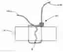 Fig. 01 - Threadable knot soft tissue defect repair system