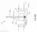 Fig. 40 - Threadable knot soft tissue defect repair system