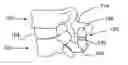 Fig. 01 - Inter spinous process spacer with compressible core providing dynamic stabilization