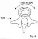 Fig. 04 - Inter spinous process spacer with compressible core providing dynamic stabilization