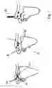 Fig. 02 - Bone repair eyelet