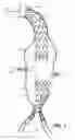 Fig. 02 - Stent Graft