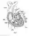Fig. 02 - Prosthetic heart valve system with positioning markers