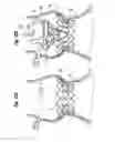 Fig. 09 - Prosthetic heart valve system with positioning markers