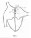 Fig. 02 - Devices, systems and methods to treat heart failure