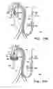 Fig. 49 - Valve prosthesis with movably attached claspers with apex