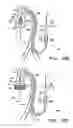 Fig. 49 - Methods for delivery of a sutureless pulmonary or mitral valve