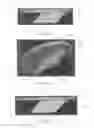 Fig. 02 - SURGICALLY IMPLANTABLE KNEE PROSTHESIS WITH CAPTURED KEEL