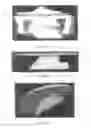 Fig. 06 - SURGICALLY IMPLANTABLE KNEE PROSTHESIS WITH CAPTURED KEEL