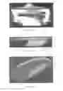 Fig. 09 - SURGICALLY IMPLANTABLE KNEE PROSTHESIS WITH CAPTURED KEEL