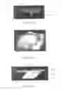 Fig. 22 - SURGICALLY IMPLANTABLE KNEE PROSTHESIS WITH CAPTURED KEEL