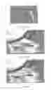Fig. 33 - SURGICALLY IMPLANTABLE KNEE PROSTHESIS WITH CAPTURED KEEL