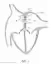 Fig. 02 - Devices, systems and methods to treat heart failure
