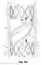 Fig. 06 - Device for regulating blood flow