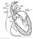 Fig. 04 - Multipiece prosthetic mitral valve and method