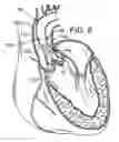 Fig. 05 - Multipiece prosthetic mitral valve and method
