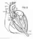 Fig. 06 - Multipiece prosthetic mitral valve and method