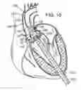 Fig. 07 - Multipiece prosthetic mitral valve and method
