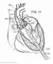 Fig. 08 - Multipiece prosthetic mitral valve and method