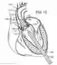 Fig. 09 - Multipiece prosthetic mitral valve and method