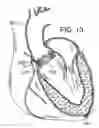 Fig. 10 - Multipiece prosthetic mitral valve and method