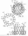 Fig. 11 - Multipiece prosthetic mitral valve and method
