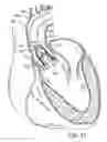 Fig. 12 - Multipiece prosthetic mitral valve and method