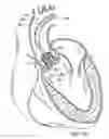 Fig. 13 - Multipiece prosthetic mitral valve and method