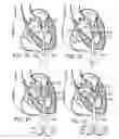 Fig. 14 - Multipiece prosthetic mitral valve and method