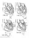 Fig. 15 - Multipiece prosthetic mitral valve and method