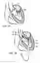 Fig. 16 - Multipiece prosthetic mitral valve and method