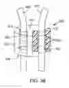 Fig. 20 - Multipiece prosthetic mitral valve and method