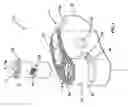 Fig. 02 - Method of installation of intervertebral spacers