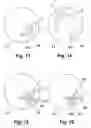 Fig. 09 - System for defining cuts in eye tissue