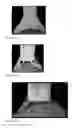 Fig. 07 - Method for welding tip of electrode in spark plug