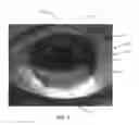 Fig. 08 - Ocular surface interferometry (OSI) methods for imaging, processing, and/or displaying an ocular tear film